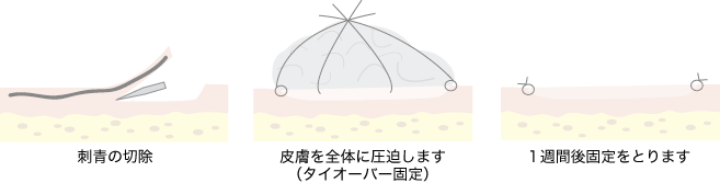 植皮術の良し悪し2