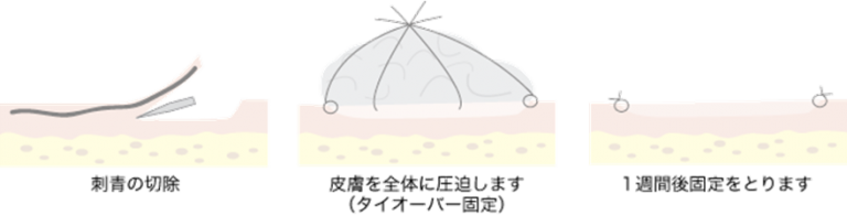 削皮・植皮 | 横浜市の刺青除去専門 | あざみ野駅前形成外科・センター南形成外科皮フ科